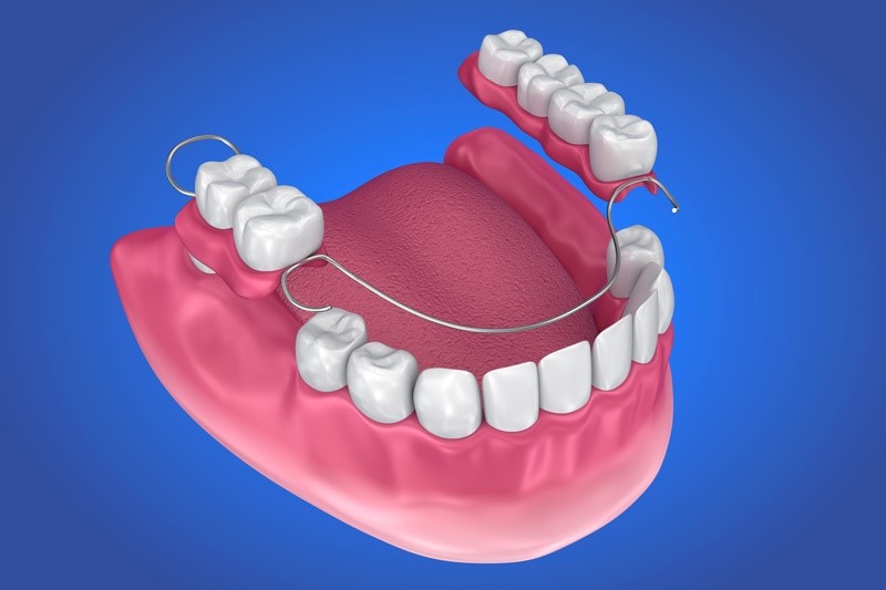 Permanent Dentures Bartlett TX 76511